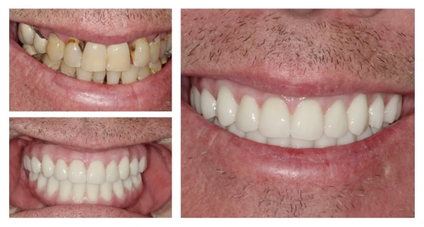 before and after cosmetic dental treatment