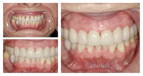 before and after cosmetic dental treatment