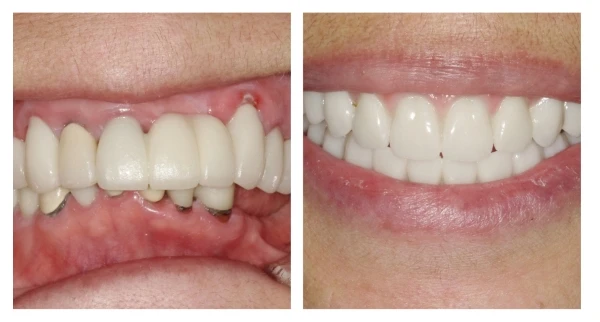 before and after cosmetic dental treatment